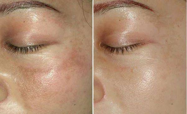 ashine led light therapy help melasma