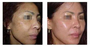 case of red light therapy help melasma