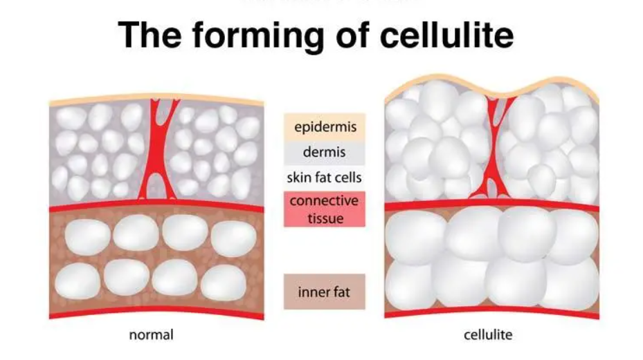 red light therapy for cellulite 1