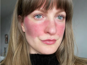 red light therapy for rosacea